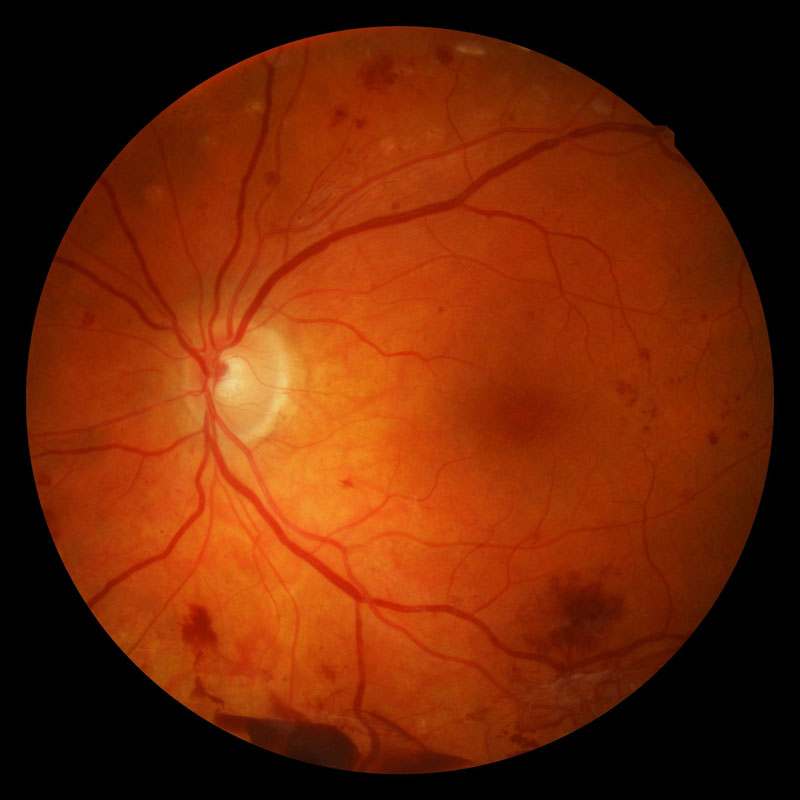 icd 10 code for diabetic retinopathy os